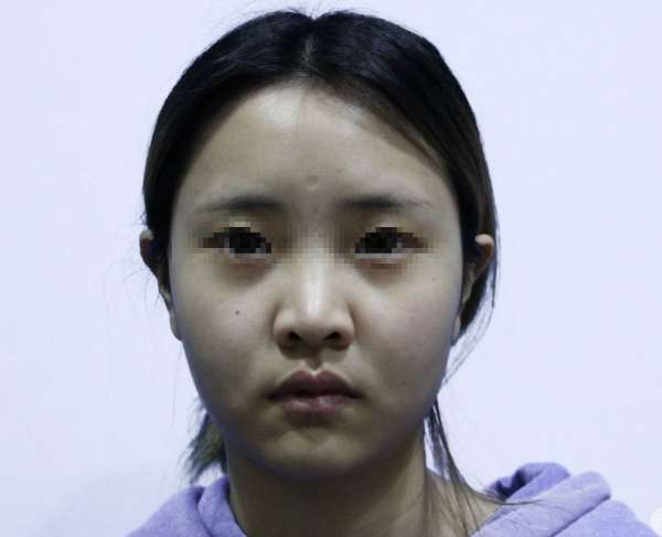 广州军美王世虎修复鼻头增生.歪鼻怎么样?王世虎鼻整形案例效果图及价格