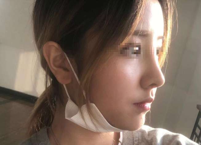 广州军美王世虎修复鼻头增生.歪鼻怎么样?王世虎鼻整形案例效果图及价格