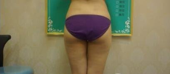 广州美莱孙延辉吸脂怎么样?口碑好不好?孙延辉吸脂案例效果图_价格