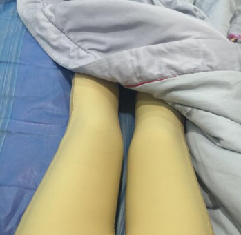 广州美莱孙延辉吸脂怎么样?口碑好不好?孙延辉吸脂案例效果图_价格