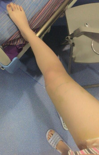 广州美莱孙延辉吸脂怎么样?口碑好不好?孙延辉吸脂案例效果图_价格