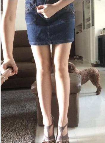 广州美莱孙延辉吸脂怎么样?口碑好不好?孙延辉吸脂案例效果图_价格