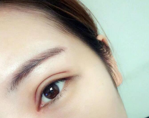 杭州黛雅周君芳双眼皮整形怎么样?会失败吗?周君芳案例效果_口碑评价_预约方式