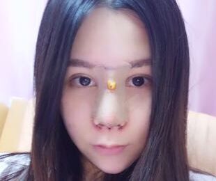 杭州维多利亚刘中策做鼻子怎么样?会失败吗?刘中策鼻整形案例效果图及价格