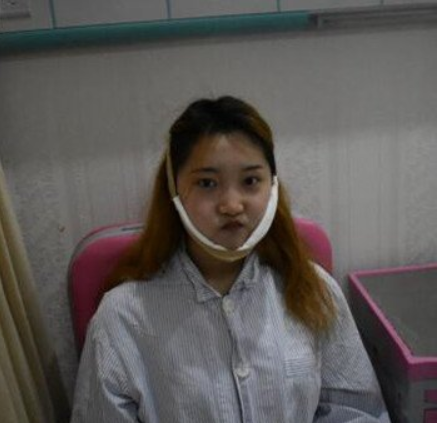 上海九院韦敏怎么预约?想挂上海九院韦敏医生的号做下颌角磨骨手术