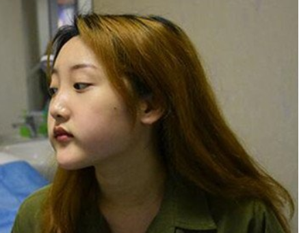 上海九院韦敏怎么预约?想挂上海九院韦敏医生的号做下颌角磨骨手术