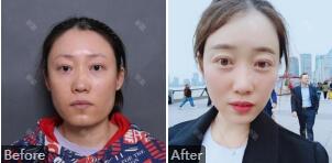 上海九院韦敏到底如何?找韦敏做磨骨手术会不会失败，出现下垂、嘴歪症状?
