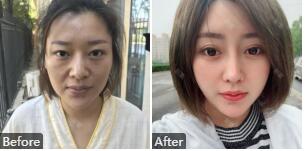 深圳非凡李寒松是韩国医生吗?附李寒松整形技术_案例_手术价格表