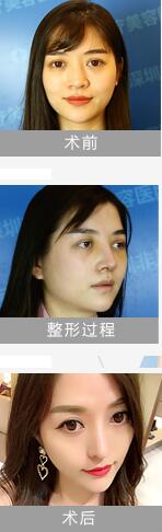 深圳非凡梅够明院长技术怎么样?梅够明鼻整形案例效果图及价格