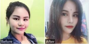 石家庄蓝山王兴奎整形怎么样?王兴奎手术风格_隆鼻、修复双眼皮案例_价格