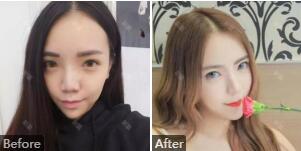 河北省中医院毛俊涛怎么样?毛俊涛手术风格_隆鼻、自体脂肪填充案例_价格_出诊时间