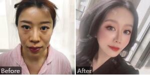 河北省中医院毛俊涛怎么样?毛俊涛手术风格_隆鼻、自体脂肪填充案例_价格_出诊时间