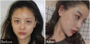 石家庄天伊美张柏松隆鼻怎么样?张柏松鼻整形技术_风格_鼻综合案例_价格