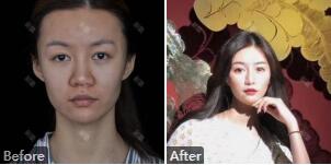 石家庄贵美人何静隆鼻怎么样?何静整形技术_鼻综合、双眼皮案例_价格
