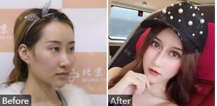 石家庄贵美人何静隆鼻怎么样?何静整形技术_鼻综合、双眼皮案例_价格