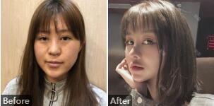 石家庄星源美天赵延峰做鼻子怎样?赵延峰鼻整形技术_案例_价格