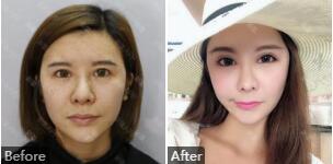 北京彤美候舍予教授权威吗?候舍予整形技术_手术风格_修复双眼皮案例_价格