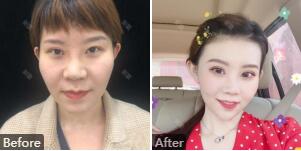 杭州市一贾明怎么样?贾明医生坐诊时间_联系方式_双眼皮修复整形案例效果(图)