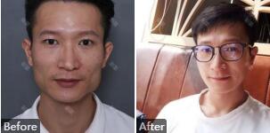 北京八大处磨腮谁做的好_八大处磨骨专家排行榜及手术价格费用