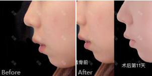北京八大处磨骨谁磨的好_靳小雷磨骨安全、风格自然_真人案例效果