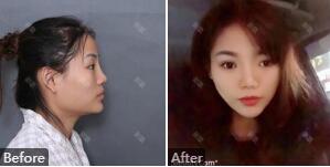 北京八大处磨骨谁磨的好_靳小雷磨骨安全、风格自然_真人案例效果
