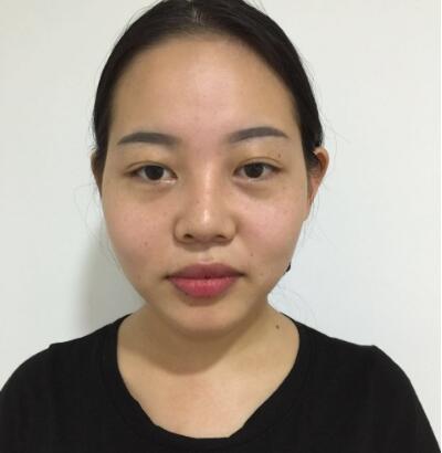 北京八大处注射美容谁好?八大处陈光宇注射瘦脸案例效果_价格