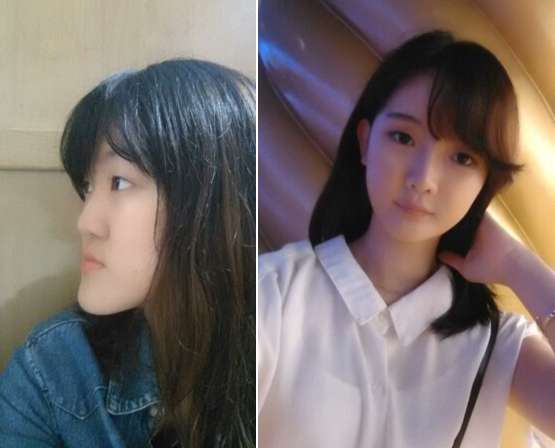 上海九院韦敏做双颌手术怎么样?想知道九院韦敏双颌前突矫正真人案例效果、反馈?