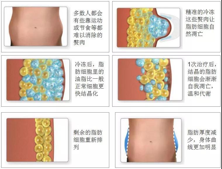 四川美莱酷塑冷冻减脂术让你躺着就能瘦瘦瘦!附真人案例效果图