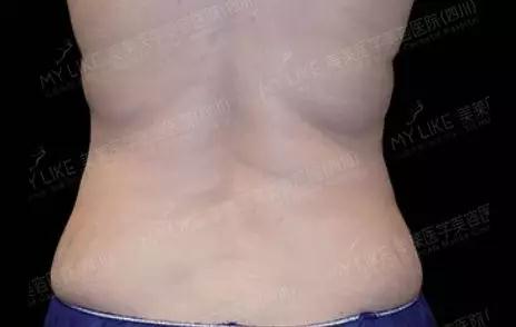 四川美莱酷塑冷冻减脂术让你躺着就能瘦瘦瘦!附真人案例效果图