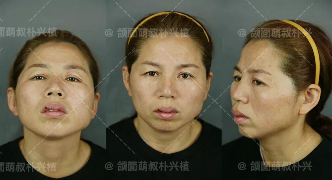上海首尔丽格朴兴植做颜面轮廓手术技术怎么样?朴兴植轮廓改脸真人案例效果