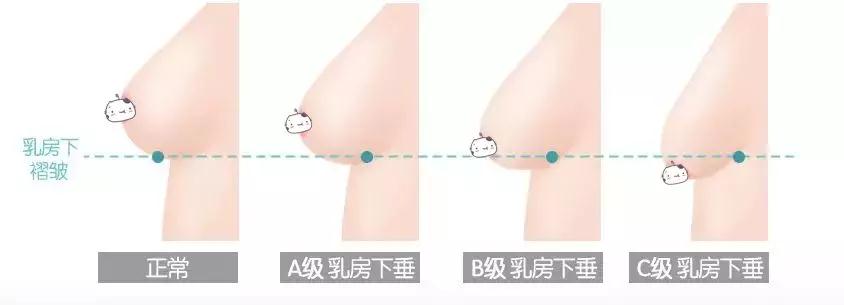 成都华美紫馨宋晓东少女水球波重塑矫正胸部下垂、外扩_真人丰胸案例