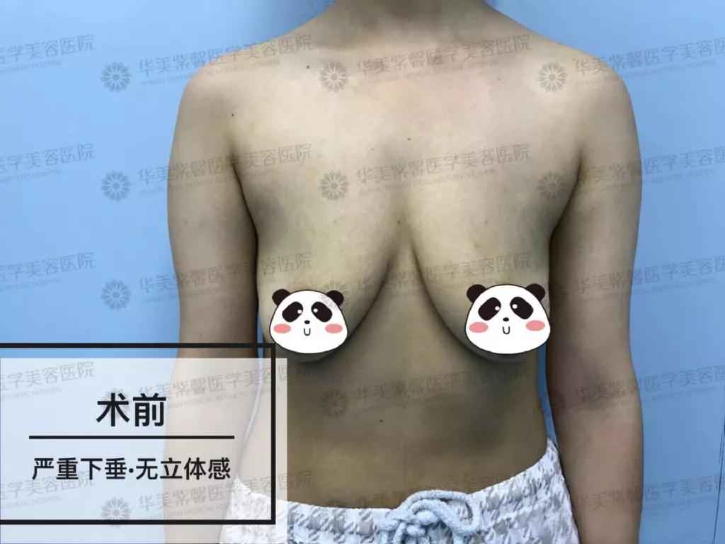 成都华美紫馨宋晓东少女水球波重塑矫正胸部下垂、外扩_真人丰胸案例