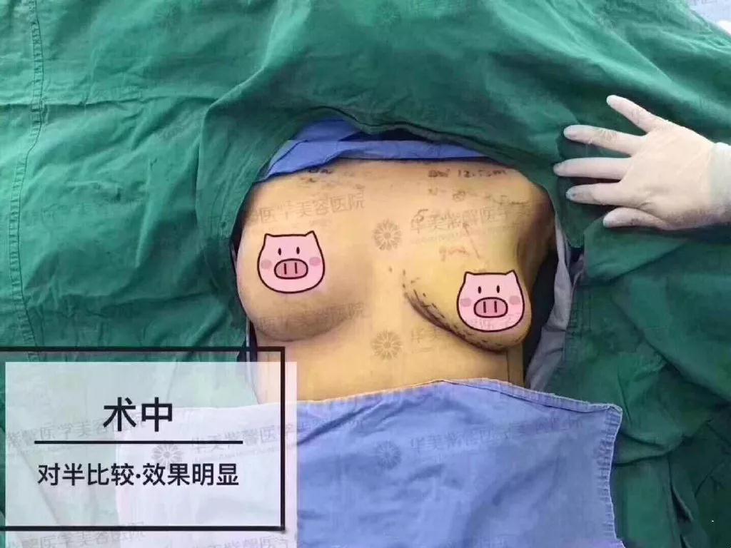 成都华美紫馨宋晓东少女水球波重塑矫正胸部下垂、外扩_真人丰胸案例