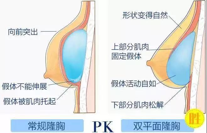 成都华美紫馨宋晓东少女水球波重塑矫正胸部下垂、外扩_真人丰胸案例