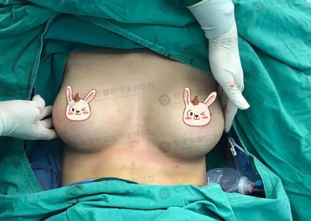 成都华美紫馨宋晓东少女水球波重塑矫正胸部下垂、外扩_真人丰胸案例