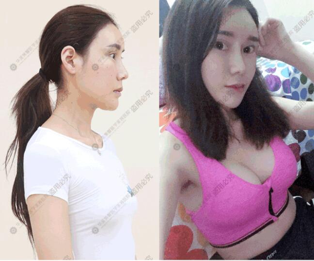 成都华美紫馨宋晓东少女水球波重塑矫正胸部下垂、外扩_真人丰胸案例