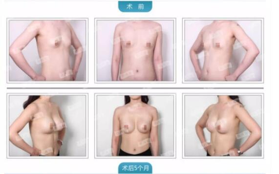 成都悦好裴柄万极速丰胸怎么样?裴柄万丰胸案例效果