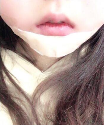 北医三院成形科李东做假体垫下巴手术怎么样?多少钱?真人案例效果?