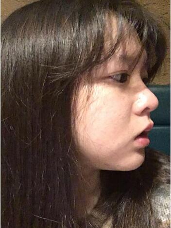 北医三院成形科李东做假体垫下巴手术怎么样?多少钱?真人案例效果?