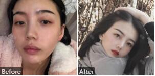 郑大二附院刘月丽整形技术怎样?刘月丽擅长项目_双眼皮案例_价格