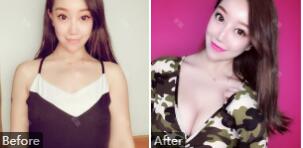 郑大二附院刘月丽、李纲谁做丰胸手术效果更好?附案例、价格
