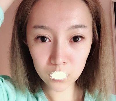 深圳京韩乔爱军脂肪填充真有那么牛吗?乔爱军吸脂面填案例效果及恢复过程图