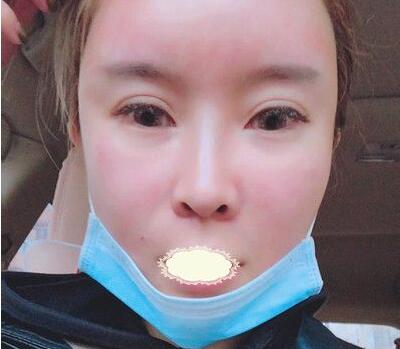 深圳京韩乔爱军脂肪填充真有那么牛吗?乔爱军吸脂面填案例效果及恢复过程图