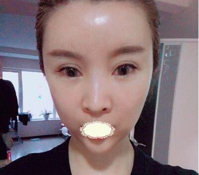 深圳京韩乔爱军脂肪填充真有那么牛吗?乔爱军吸脂面填案例效果及恢复过程图