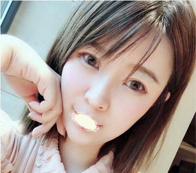 深圳京韩乔爱军脂肪填充真有那么牛吗?乔爱军吸脂面填案例效果及恢复过程图