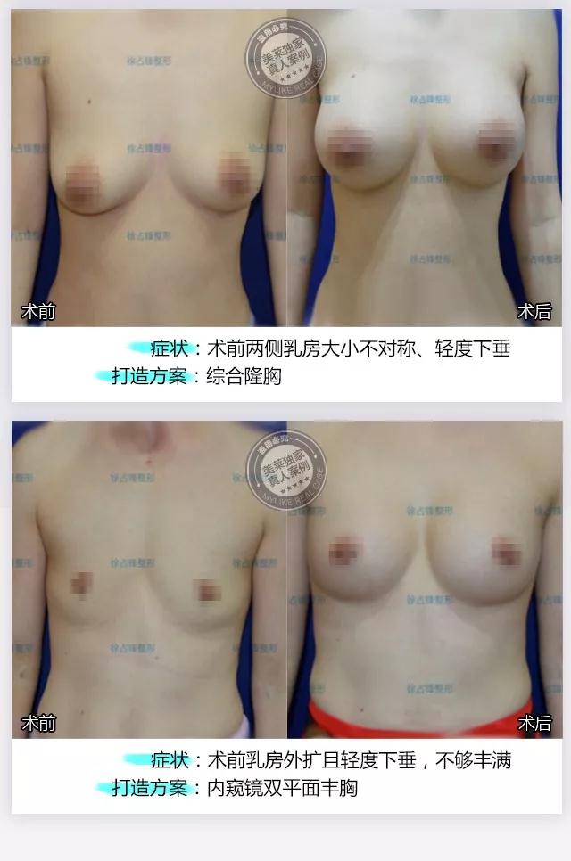 深圳美莱徐占峰擅长自体脂肪隆胸还是假体隆胸?真人隆胸案例效果?