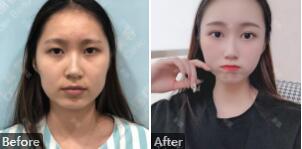 深圳金丽张德清自体脂肪填充技术怎么样?张德清手术风格_真人案例_价格