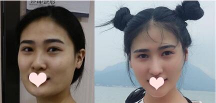 深圳阳光罗志敏隆鼻好还是深圳金丽朱冠峰隆鼻好?医生资质、案例效果对比