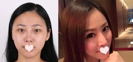 深圳阳光罗志敏隆鼻好还是深圳金丽朱冠峰隆鼻好?医生资质、案例效果对比