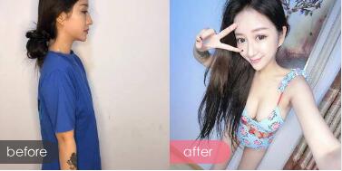 深圳鹏程马强整形技术怎么样?马强擅长项目_双眼皮案例效果_价格表